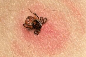 Опасность энцефалитных клещей