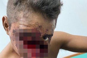 Травма после удара топором по лицу