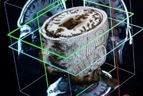 Искусственный интеллект поможет распознать деменцию на ранних стадиях