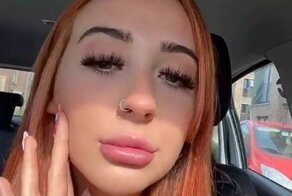 Девушка решила уменьшить губы и чуть не попрощалась с жизнью