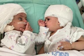 В Израиле провели уникальную операцию по разделению сиамских близнецов