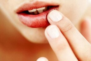 Герпес на губах