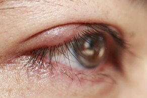 Как быстро вылечить ячмень