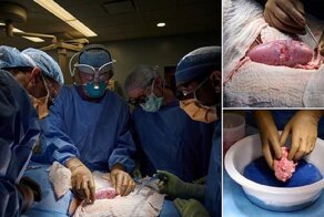 Хирурги успешно пересадили человеку почки свиньи
