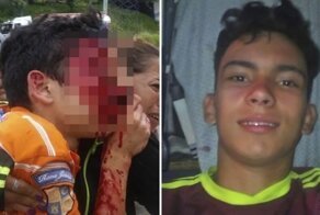 Подросток потерял оба глаза после того, как полиция выстрелила ему в лицо во время акции протеста