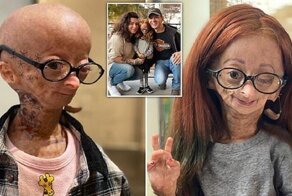 Сетевая знаменитость скончалась от болезни Бенджамина Баттона в 15 лет