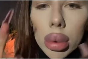 Пельмени вместо губ снова в моде?