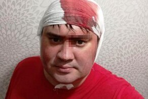 В Новосибирске мужчине в голову неожиданно прилетел топор