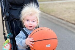 Как выглядит крайне редкий синдром "непослушных волос"