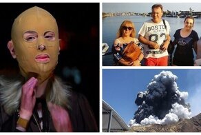 Обгоревшая во время извержения вулкана женщина показала своё лицо