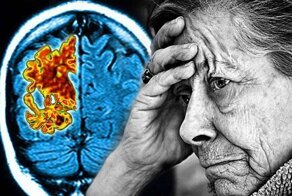 Нетикающие часики: как выявить подкрадывающуюся деменцию доступными способами?