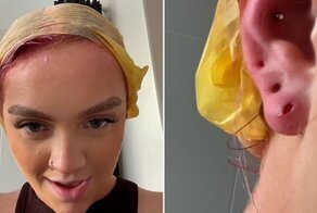Женщина потеряла часть уха из-за дешевых сережек