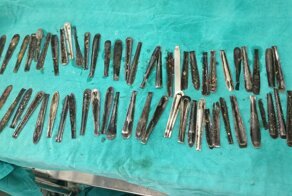 Индийцу удалили из желудка 63 рукоятки ложек