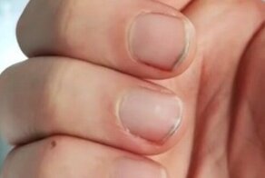 Одна из причин перестать грызть ногти