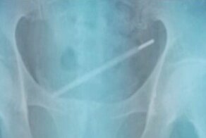 От скакалок до ручек: что люди засовывают в свои мочевые пузыри