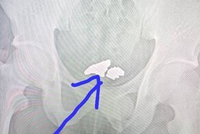 Работник проглотил украденное золото, но попался благодаря дверной сигнализации