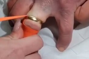 Как снять кольцо с опухшего пальца