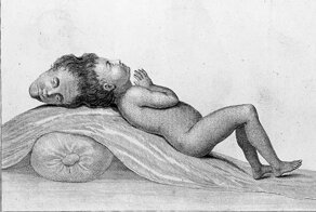 Бенгальский мальчик – один из первых зафиксированных случаев паразитарных краниопагов