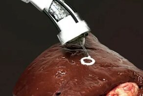 В Австралии разработали устройство для 3D-печати клеток на органах внутри тела