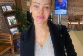 Парень из ревности облил девушку кислотой, но она восстала из пепла, как Феникс, и живёт счастливо