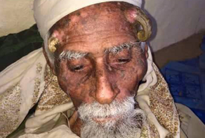 140-летний йеменец умер после удаления рогов. Говорят, они выросли после сделки с Дьяволом