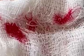 В Волгограде комар заразил мужика червяком