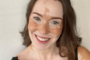 Особенные люди с витилиго, которые больше не стесняются себя и своего тела