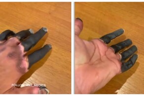 Альпинист показал, как выглядят обмороженные пальцы перед ампутацией