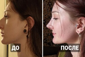 18 смельчаков, которые решились на пластическую операцию и не пожалели об этом