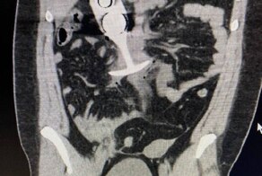 В США мужчина пошёл на МРТ с анальной пробкой в заднем проходе и чуть не погиб от разрыва внутренних органов