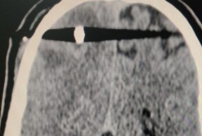 Серпуховские врачи спасли мужчину с пулей в голове