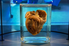 Спустя 16 лет женщина увидела своё сердце в музее