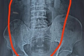 В Индии врачи удалили пациенту пластиковую бутылку из желудка