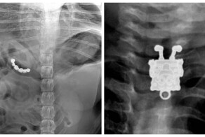 У них это было в теле: 17 удивительных рентгеновских снимков