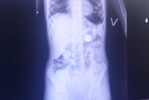 6-летний мальчик проглотил монетку ради любопытства