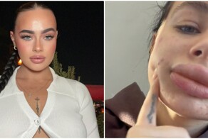 Девушка увеличила губы и пожалела об этом - своим неудачным опытом она поделилась в соцсетях