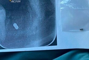 Стоматолог из Новосибирска забыл в челюсти пациентки часть сверла от бормашины