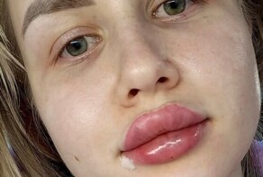 Девушки поделились фото «надувных» губ и напугали пользователей сети
