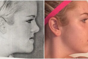 Люди, которые решились на пластику - и теперь любуются своим отражением в зеркале