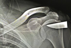 Неожиданная находка: врачи из Подмосковья обнаружили в плече пациента обломок клинка