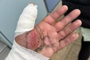 Мужчина получил серьезный ожог, меняя аккумулятор в вейпе