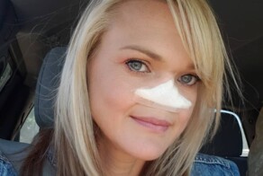 Лишившаяся носа женщина&nbsp;решила отказаться от протеза