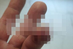 В Москве пьяный посетитель клуба приставал к девушкам, а потом откусил охраннику часть пальца