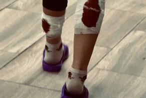 В Ивановской области покусанной собаками девочке не смогли оказать медицинскую помощь