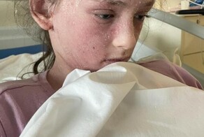 У 11-летней девочки развилась аллергия на собственные слёзы и пот