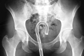 Медик рассказала о любителях засовывать в себя разные предметы