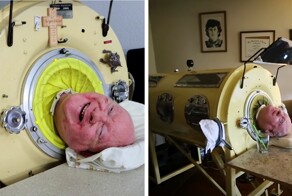 Человек с "железными лёгкими" умер в возрасте 78 лет