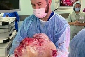 Хирурги Склифа удалили опухоль весом 10 кг, внутри которой нашли зубы⁠⁠