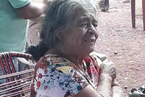 81-летняя женщина 56 лет прожила с «каменным ребёнком» в животе