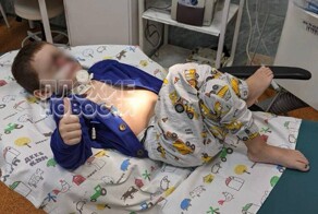 В России провели уникальную операцию по спасению лица ребенка, изуродованного собакой